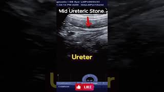 Ultrasound Tracing the mid Ureteric Stone          #ultrasound #stone #calculus