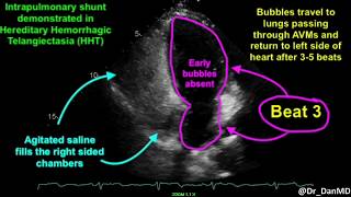 Pulmonary Arteriovenous Malformations (AVMs) in HHT