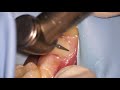 filling a cavity can gumline decay be fixed with tooth colored fillings