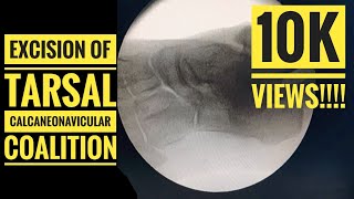 Excision of Tarsal Calcaneonavicular Coalition