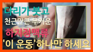 다리가 붓고 천근만근 무거운 중년 하지정맥류 이 운동 하나로 예방하세요