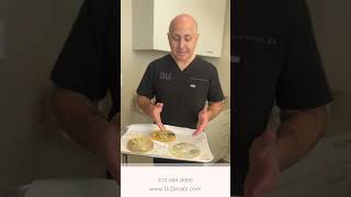 Different Implant Shapes | Dr. Zarrabi #shorts