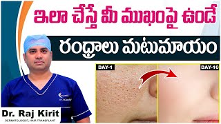 ముఖంపై గుంతలు పోవాలంటే | How to Close Open Pores Permanently | Celestee Skin And Hair Clinic