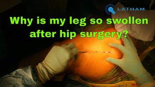 Why is my leg so swollen after hip surgery?
