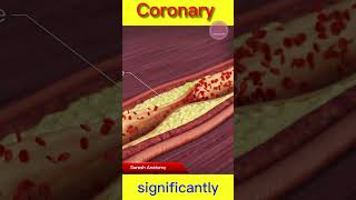 Coronary Angioplasty: A Lifesaving Procedure for Clogged Arteries #coronaryangioplasty #hearthealth