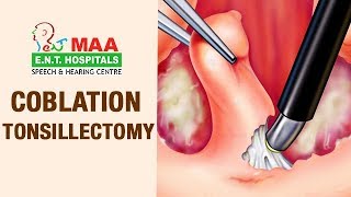 COBLATION Tonsillectomy | Dr.K.R.Meghanadh | MAA ENT Hospitals.