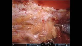 eTEP How to Series - Dissecting entire pre peritoneal space