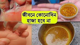 শুধু ১ বার লাগান।জীবনে আর কোনোদিন হাজা হবে না। Leg Skin Haja