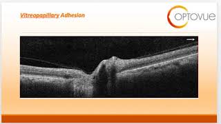 OCT Interpretation Session 2: Retinal Vascular Disease