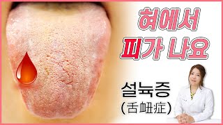 설뉵증: 아침마다 혀에서 피가 나요