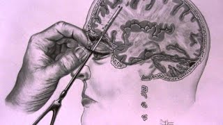 The Most TWISTED Medical Procedure in History - The Lobotomy
