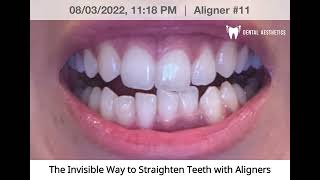 Aligners Journey | Invisible Braces Before And After