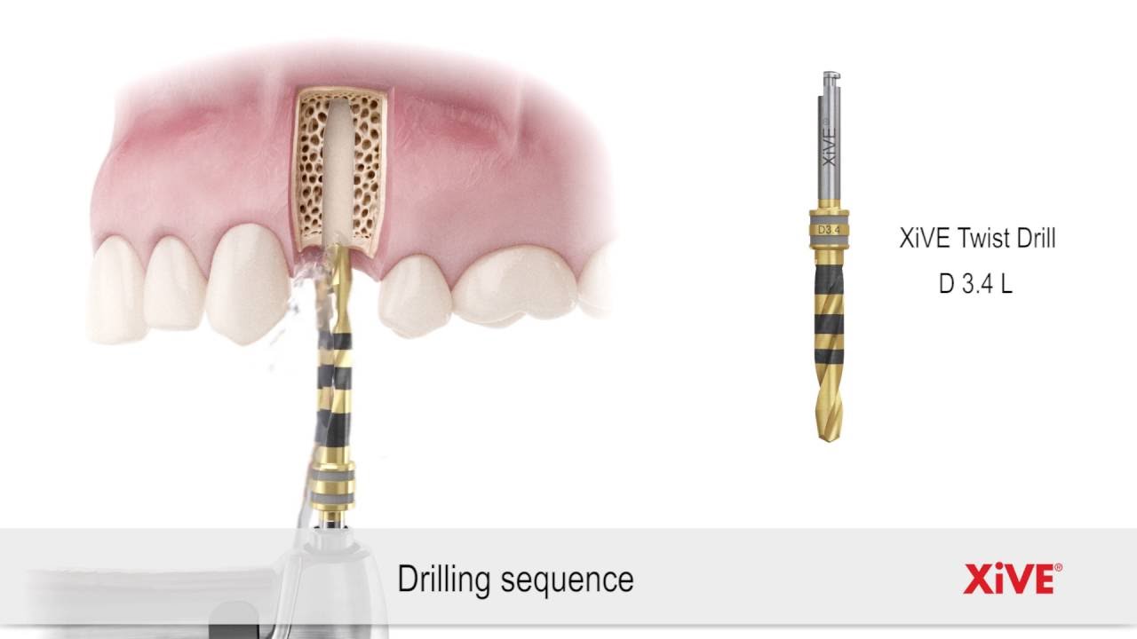 Xive Drilling Sequence And Implant Placement - YouTube