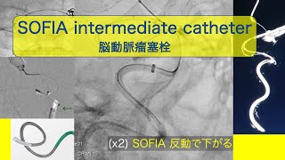 SOFIA intermediate catheter. 脳動脈瘤コイル塞栓 中間カテーテルの \