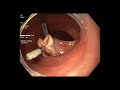 endoloop assisted polypectomy