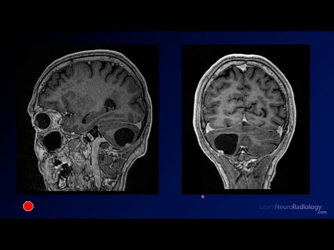 Neuroradiology Board Review - Brain Tumors - Case 6 - YouTube