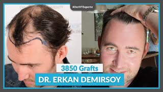 Haartransplantation Türkei ✅ Vorher - Nachher mit 3850 Grafts [Dr. Erkan Demirsoy]