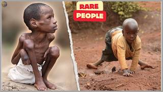 20 Unbelievable Kids Born With Rare, Extraordinary Features You Won’t Believe! – Rare People