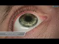 1  What is LASIK surgery