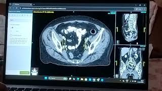 PELVIC LYMPHNODES RADIATION \u0026 ITS ANATOMY