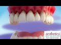 bleeding gums and pyorrhea what is gum disease aesthetica dental implant clinics