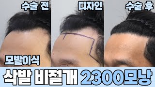 남성🧑모발이식 전후영상🎬삭발비절개 2300모낭｜모발이식｜헤어라인교정｜두피문신｜다나성형외과DANA