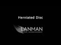 What is a herniated disc? | Dr. Todd Lanman