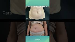 Abdominoplastika | Dermolife