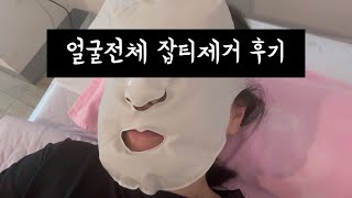 [VLOG] 내돈내산 얼굴전체 잡티제거 후기