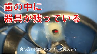 歯の中に治療に使った器具が残っている　ファイル破折(リーマー破折) broken file remove