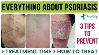 Psoriasis  छाल रोगक्या और क्यों होता है  Psoriasis Symptoms, Causes, Diagnosis, Treatment  Delhi NCR