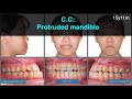 Treatment of Class III Malocclusion with Invisalign｜【Chris Chang Ortho】CC696