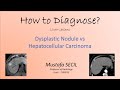 How to Diagnose - Liver 3 - Dysplastic Nodule vs HCC #liver #radiology #cancer #imaging