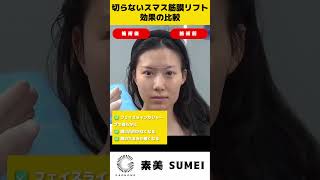 糸リフトじゃない、切らない、SMAS筋膜リフトアップで10歳若返る！ #smas筋膜 #美容 #シワ #整形 #糸リフト #美容整形 #しわ #美肌 #たるみ