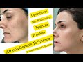 Athena Genesis Technique™ for pigmentation, open pores & rejuvenation