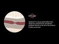 Optilume® Urethral Drug Coated Balloon for Urethral Stricture Treatment - Animation, How It Works.