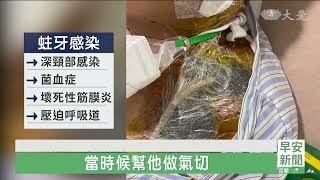 輕忽蛀牙引發感染 洗腎病患五次清創