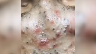 Popping huge blackheads and Giant Pimples - Best Pimple Popping Videos #123