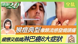 猴痘典型像類流感 發燒.頭痛!摸脖子揪出睪丸癌?當心7部位摸到腫塊!量手臂可知淋巴功能衰退了嗎?疲憊又低燒 淋巴癌6大症狀! 健康2.0 20220716 (完整版)