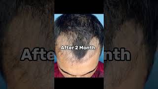 Unbelievable Hair Regrowth by Hair Transplant #shorts #haircare