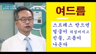 여드름의 한방치료, 스트레스 받으면 얼굴 뒤집어지고 진물, 고름 나온다