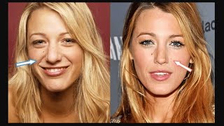 Did Blake Lively Get a Nose Job? Rumors, Transformations & Celebrity Evolution