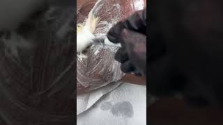 Skin Condition: Hidradenitis Suppurativa. #skin #skincare #hs #wax #esthetician #viralvideo