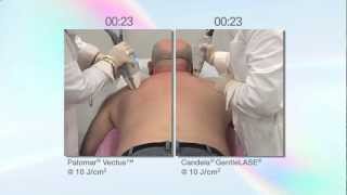 The Palomar Vectus Laser vs. the Syneron-Candela GentleLase