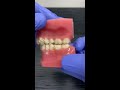 invisalign overbite and rubber bands