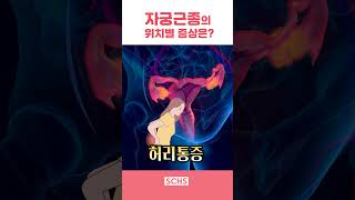 자궁근종 위치별 증상은?｜산부인과 장용수 교수 #1편 #shorts