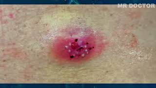 Drainage Procedure for an Infected Epidermal Cyst\