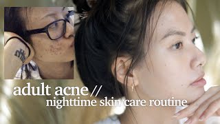 my battle with adult acne | nighttime skincare routine w tretinoin/retinoid | skincare in 30s