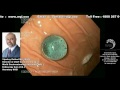 Endoscopic procedure for foreign body removal