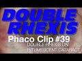 Phaco Clip #39 - Double Rhexis on Intumescent Cataract